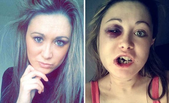 Girl says she was brutally beaten by her boyfriend after she refused to have sex with him (photos)