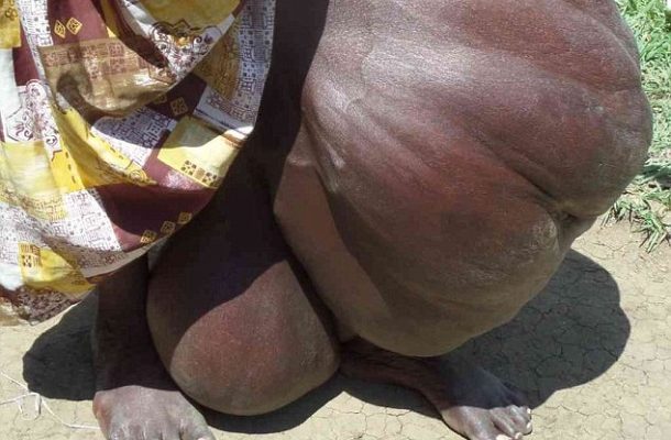 Mother grows gigantic tumour on her leg in Kenya – but is denied help after villagers claim she 'has been bewitched'