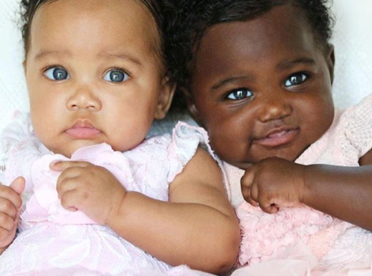 Twins with different skin tone make news headlines across the world