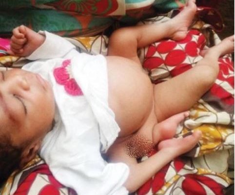 SHOCKER: 20-year old lady gives birth to a baby with 4 legs, 2 genitals