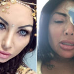 Instagram model destroys eyes in cosmetic surgery gone wrong