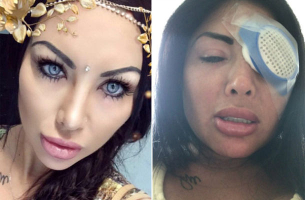 Instagram model destroys eyes in cosmetic surgery gone wrong