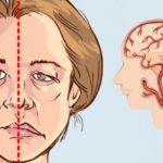 What you need to know about Stroke