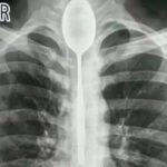 INCREDIBLE: Man lives with spoon stuck in his esophagus for a whole year