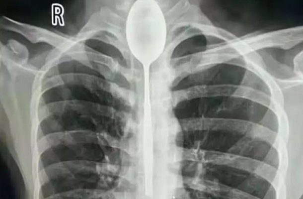 INCREDIBLE: Man lives with spoon stuck in his esophagus for a whole year