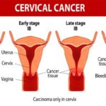 Cervical cancer: 5 Signs never to ignore