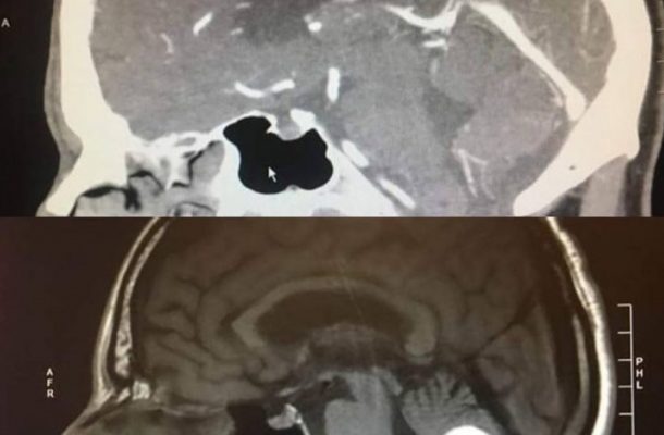 Man’s presumed brain tumour miraculously disappears day before surgery