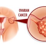 Everything you need to know about “silent killer” ovarian cancer