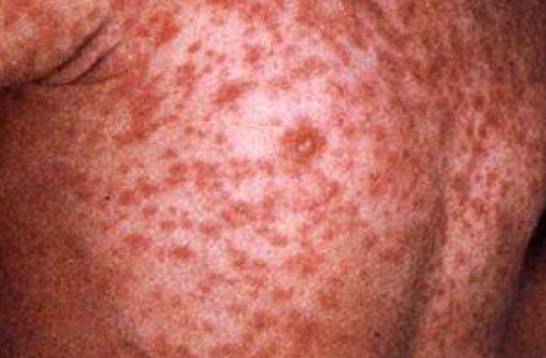 Global measles resurging – WHO warns