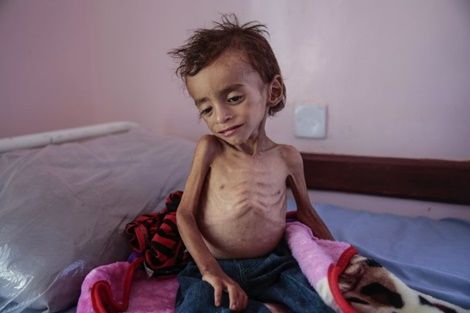 85,000 children may have died of hunger in Yemen