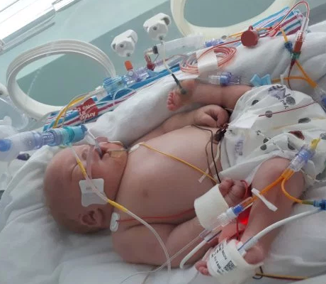 STRANGE: Baby born with legs facing the opposite direction and no buttock