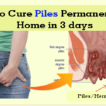 How to cure piles permanently at home in 3 days