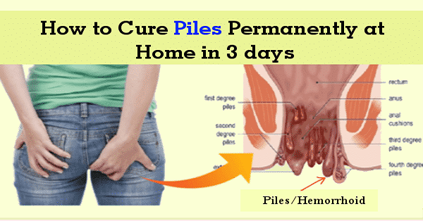 How to cure piles permanently at home in 3 days