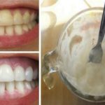 How to get rid of plaque and whiten your teeth without expensive treatments