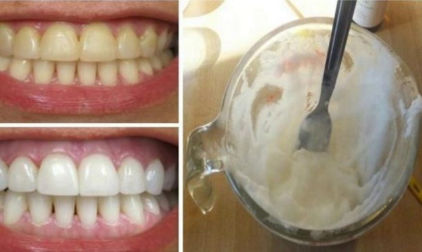 How to get rid of plaque and whiten your teeth without expensive treatments