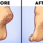 4 effective home remedy treatments for Cracks, Calluses on the foot