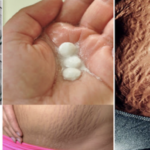 VIDEO: How to get rid of stretch marks very fast by using aspirin