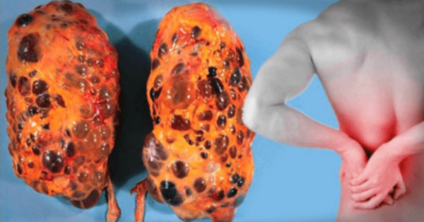 8 Bad common Habits that can damage your kidneys