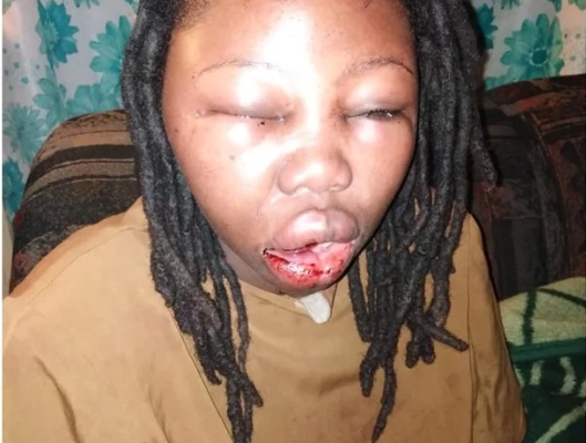 PHOTOS: Actress is beaten beyond recognition by her boyfriend for kissing in a play