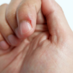 What is skin picking? A disorder dangerous than nail-biting itself!