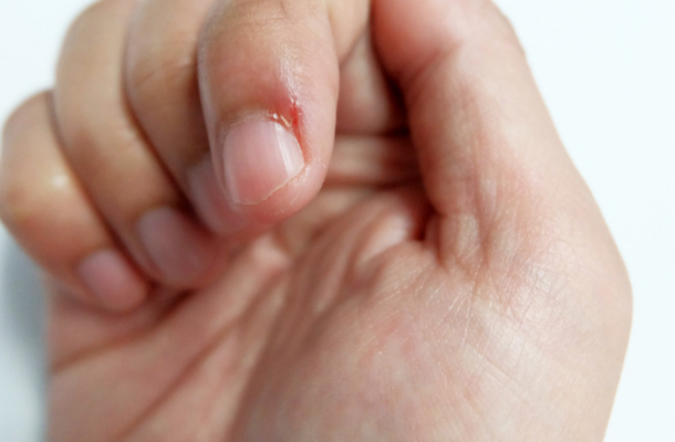 What is skin picking? A disorder dangerous than nail-biting itself!