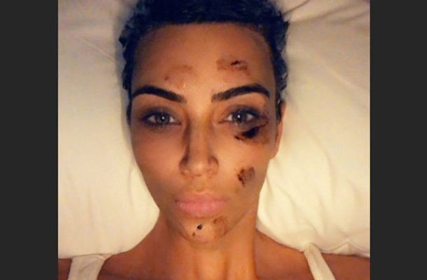 'The Sh*ts': Kim Kardashian Shares Grisly PHOTOS of Her Struggle With Psoriasis