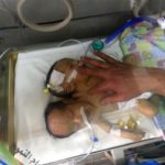 Conjoined Yemeni twins die due to Saudi blockade
