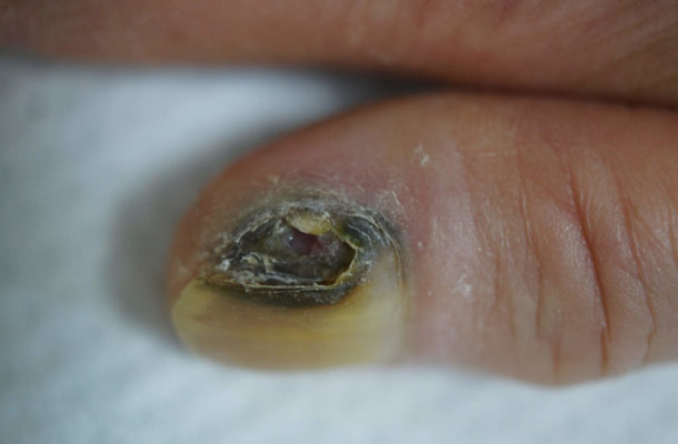 #WorldCancerDay: Never ignore this one sign on your nail