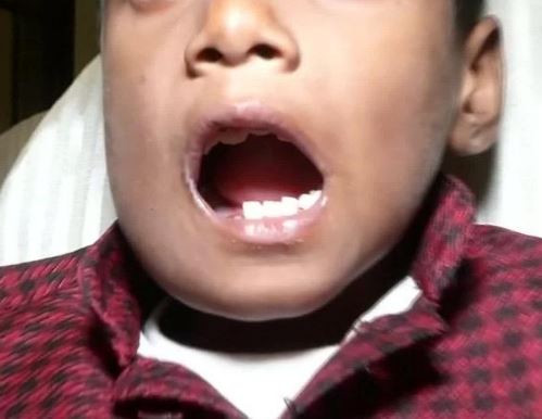 SHOCKING PHOTOS: Doctors remove 526 teeth from a 7-year old boy's mouth