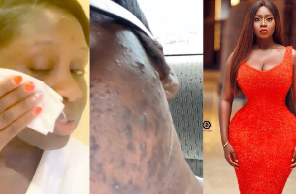 VIDEO: Princess Shyngle thankful after getting help for acne infected face