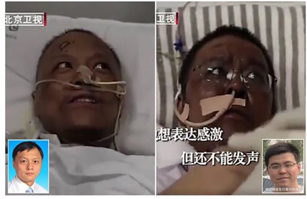 Chinese Doctors who were critically ill with Coronavirus wake up to find their skin has turned dark after beating the Virus