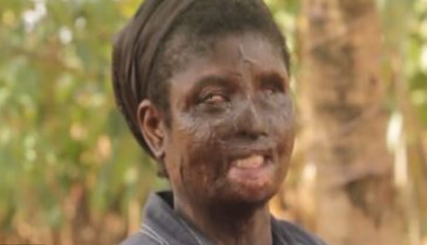 ‘I pleaded with doctors to kill me’ - Burnt woman shares ordeal
