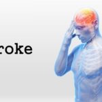 More Ghanaians at risk of getting stroke by 2040