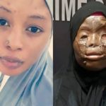 Lady who survived acid attack in Saudi Arabia undergoes plastic surgery