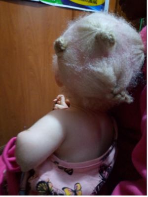Graphic photo: Baby girl's hand cut off by albino hunters pretending to be police officers