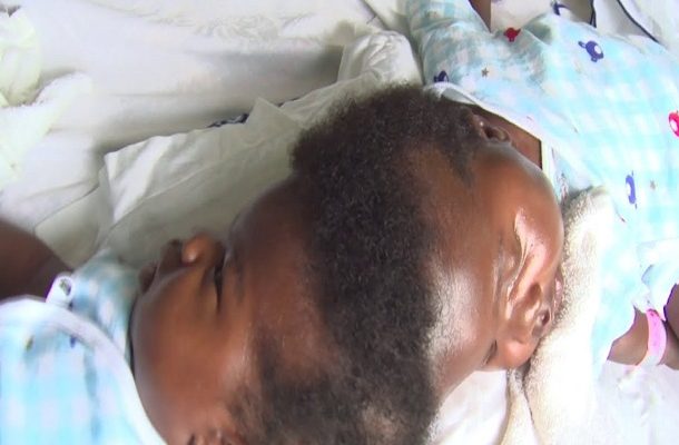 Akufo-Addo takes up cost of conjoined twins’ surgery at Ridge Hospital