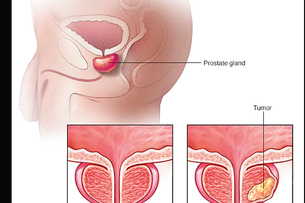 Every man has prostate!- What is wrong with yours?