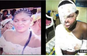Lady battling for her life after jealous boyfriend baths her with acid at Bawjiase