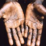 Nigeria records six monkeypox cases in May