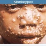 Ghana confirms five cases of Monkeypox - GHS