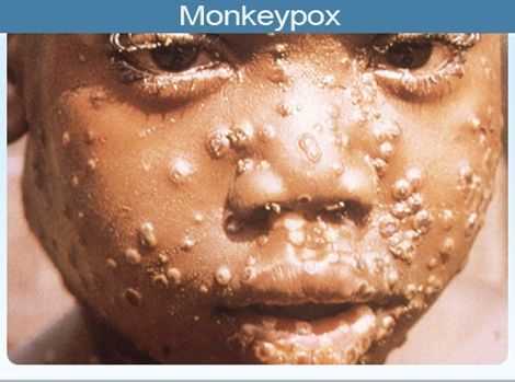 Confirmed cases of Monkeypox increase to 18 - GHS