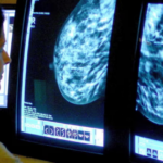 Innovative AI Tool Predicts Breast Cancer Treatment Side Effects