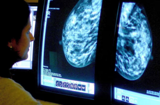 Innovative AI Tool Predicts Breast Cancer Treatment Side Effects