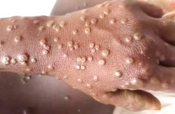 Mpox cases hit 234 with 16 new infections recorded