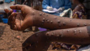 Mpox update: Ghana records 12 new infections, national case count nears 1,000