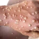 Mpox: New death recorded as GHS raises fresh concerns