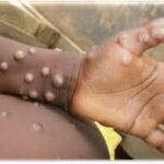GHS confirms 18 new mpox cases, total infections rise to 346