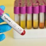 Oti Region records alarming typhoid fever cases