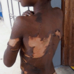 Winneba: Toddler in critical condition after stepmother pours hot water on her vagina
