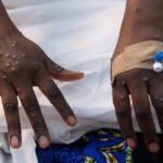 Ghana records 16 new Mpox cases as total infections near 900